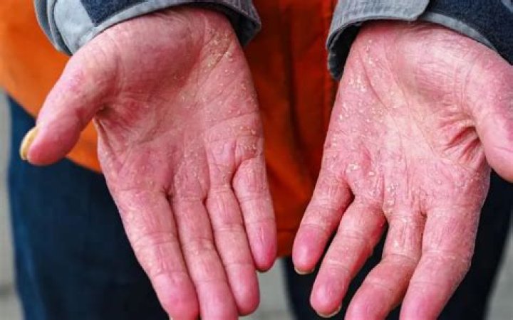 What does psoriasis on hands look like?