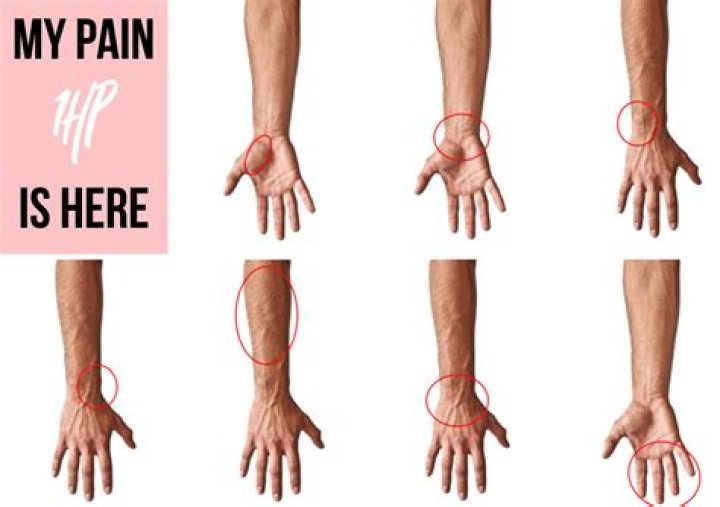 What does RSI in arm feel like?