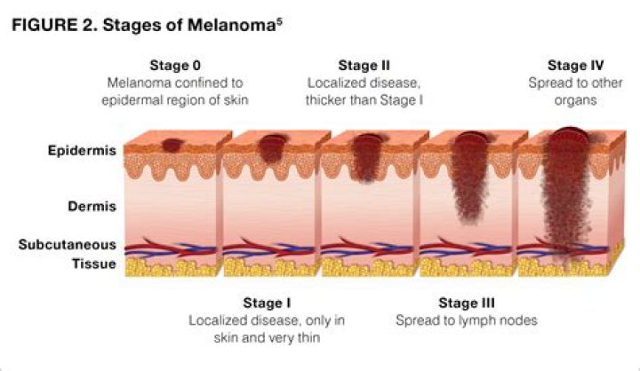 What does Stage 1 melanoma look like?