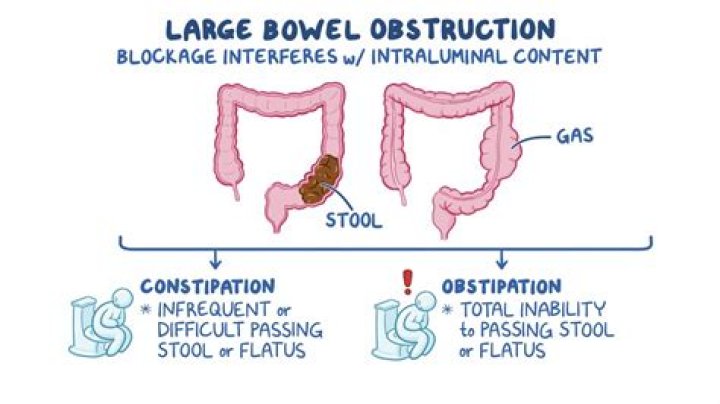 What does the start of a bowel obstruction feel like?
