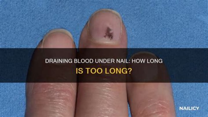 What happens if you don't drain blood under nail?