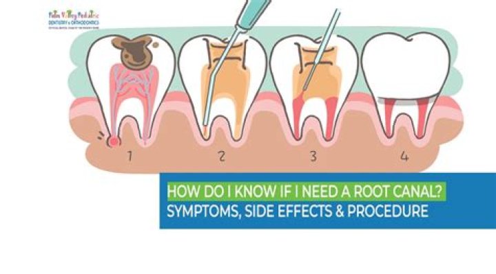 What happens if you don't get a root canal when needed?