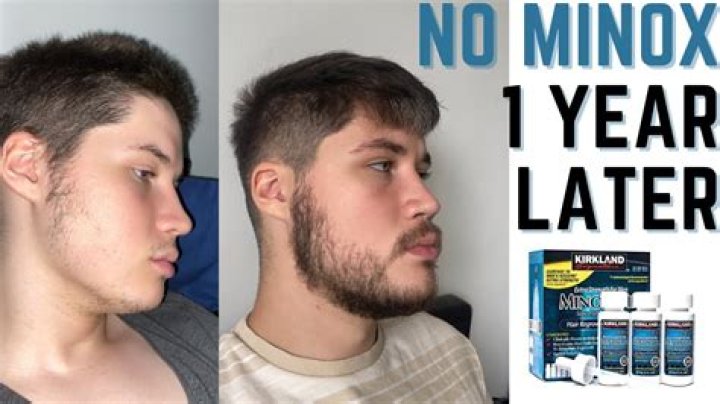 What happens if you stop minoxidil?