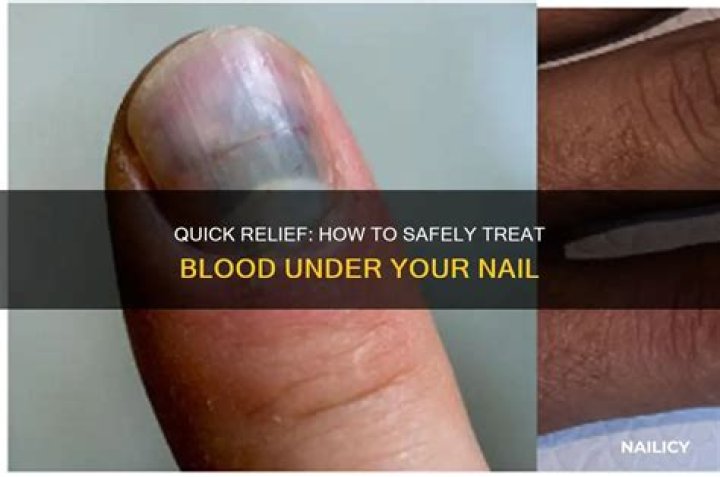 What happens to dried blood under nail?