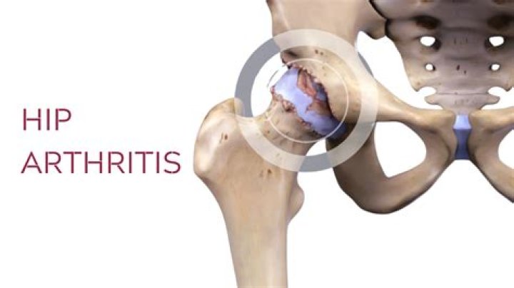 What helps arthritis in hip without surgery?