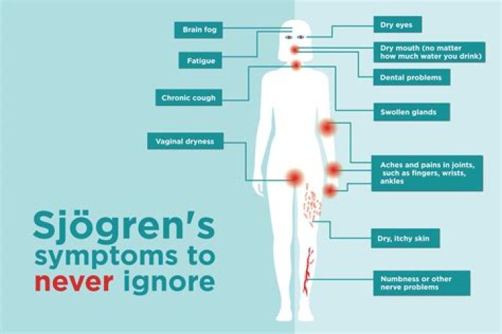 What helps Sjogren's flare up?