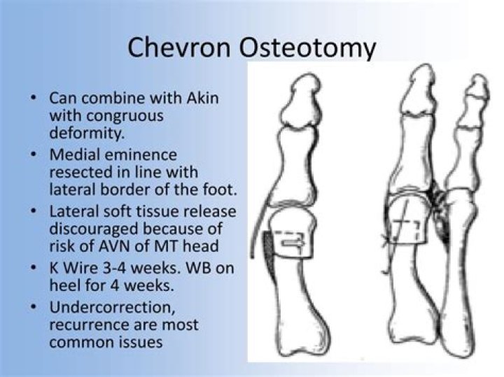 What is a chevron osteotomy?