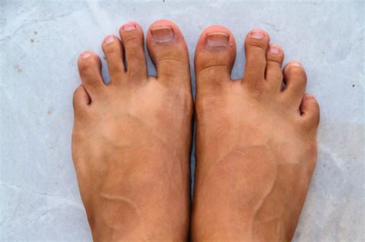 What is a curly toe?