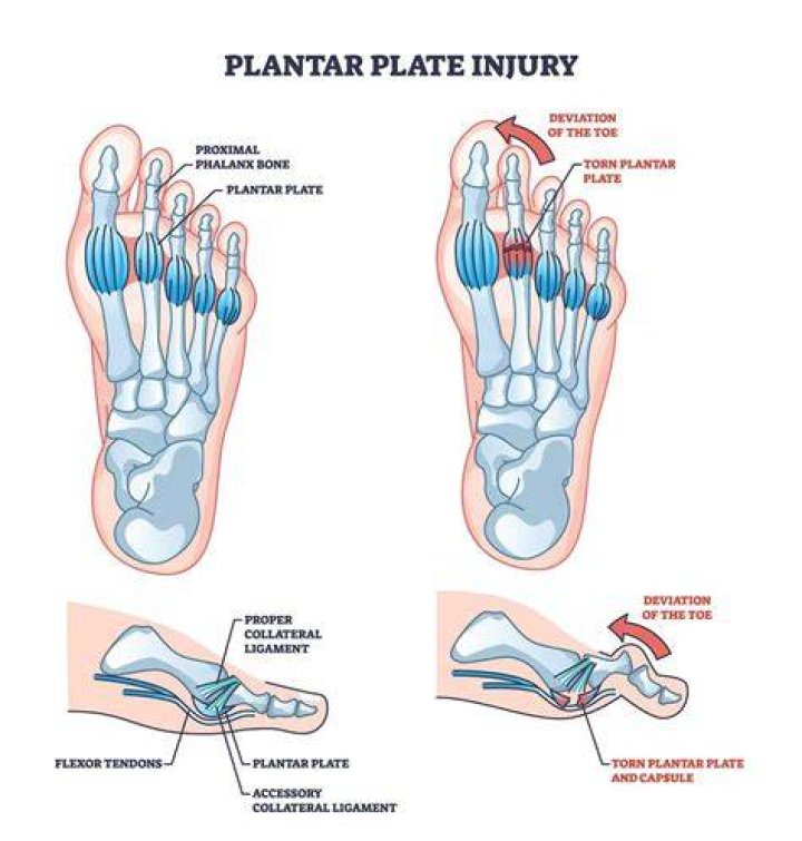 What is a ruptured plantar plate?