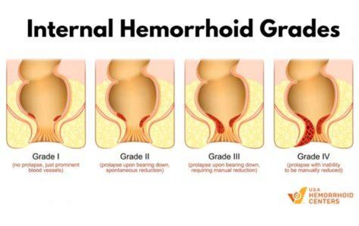 What is a Stage 3 hemorrhoid?