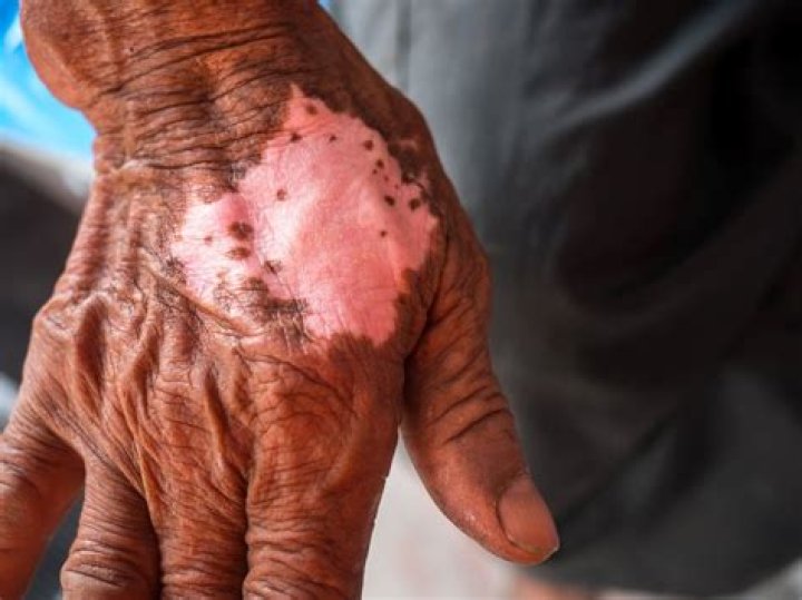 What is black leprosy?