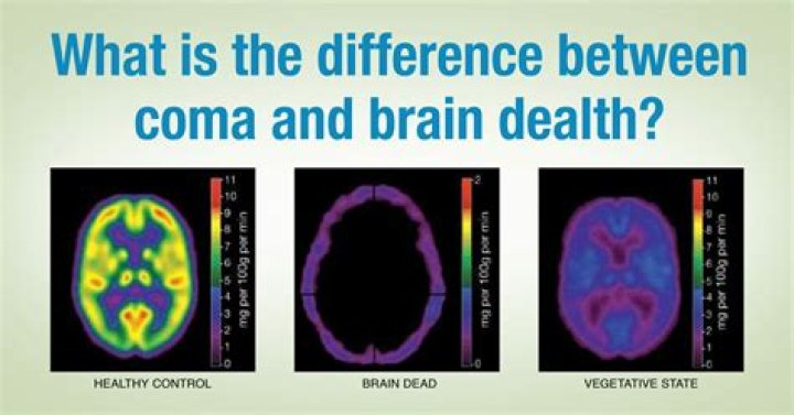 What is brain dead?