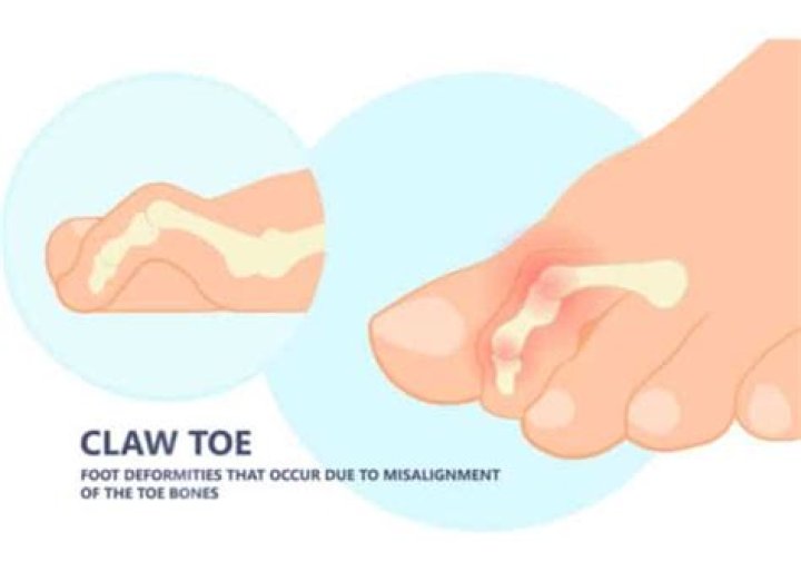 What is claw toe?