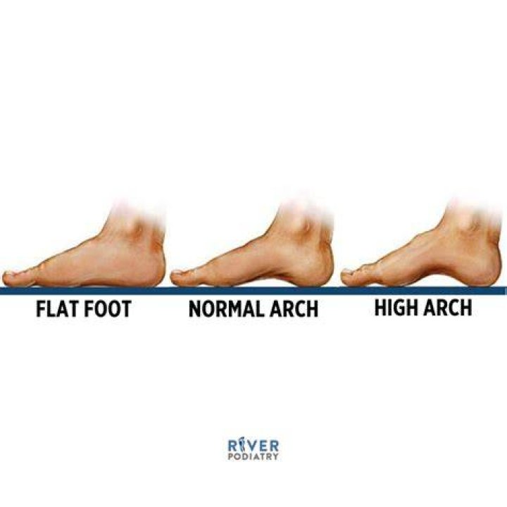What is considered a high foot arch?