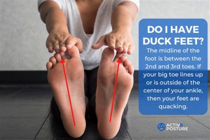 What is duck footed?