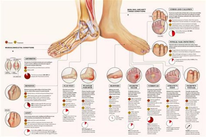 What is foot flare?
