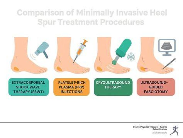 What is involved in heel spur surgery?