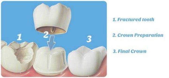 What is jacket teeth?