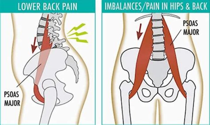 What is psoas syndrome?