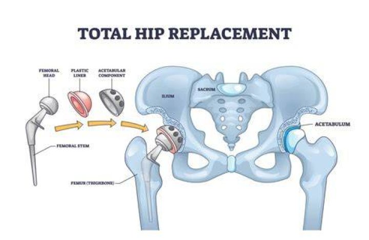 What is the best age for a hip replacement?