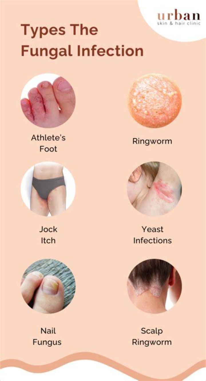 What is the best medicine for fungal infection?