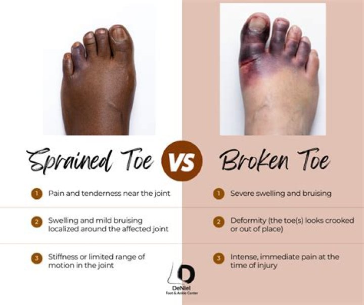 What is the fastest way to heal a sprained toe?