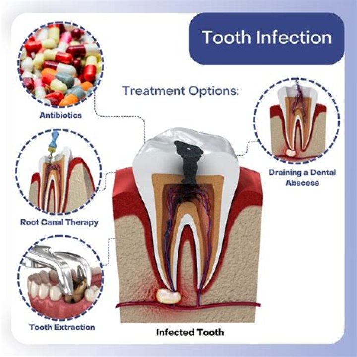 What is the strongest antibiotic for a tooth infection?