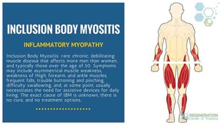 What is the treatment for myositis?