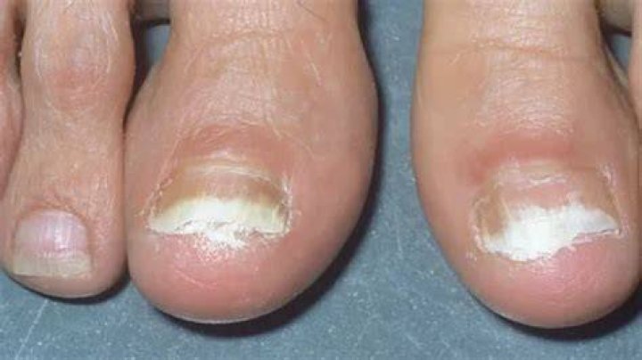 What is the white stuff under my toenails?
