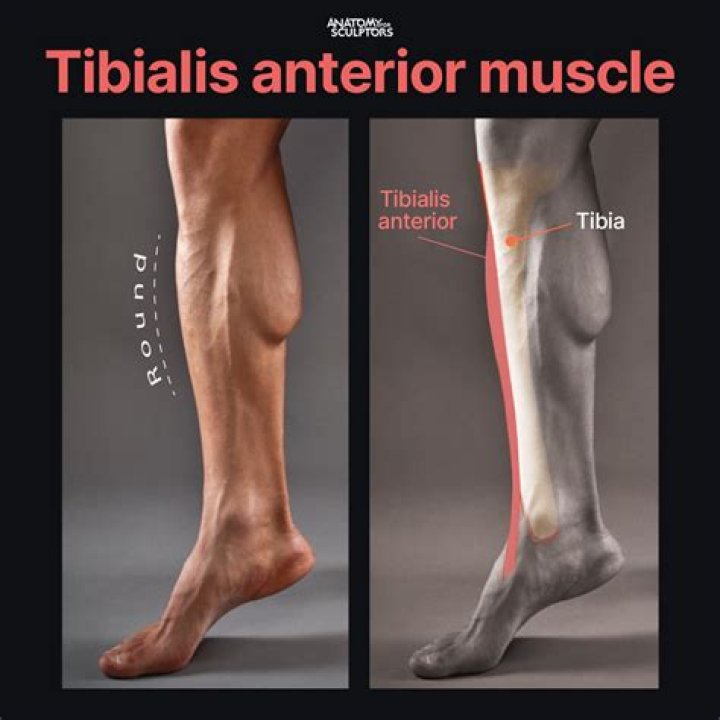 What is tibialis anterior strain?