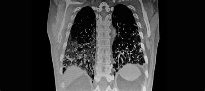 What organs does lung CT scan show?