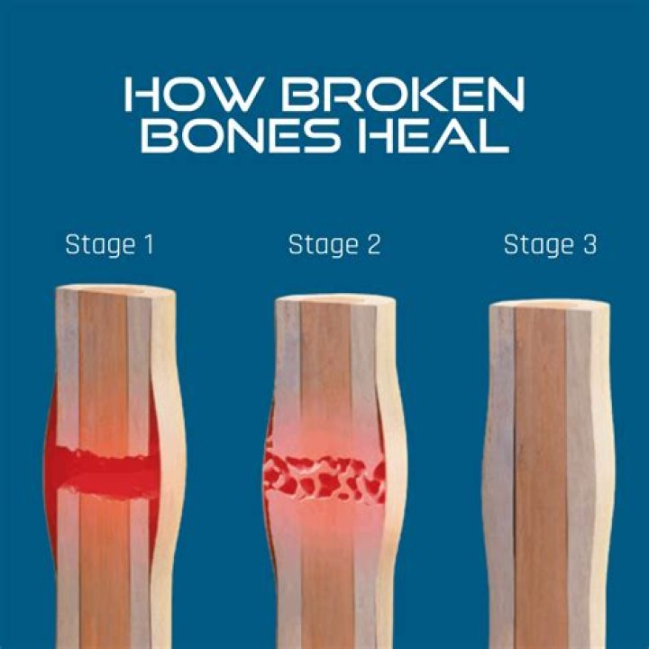 What pain reliever is good for broken bones?