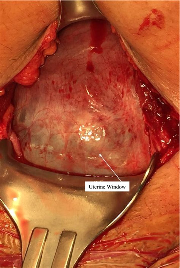 What side of the uterus is a boy on?