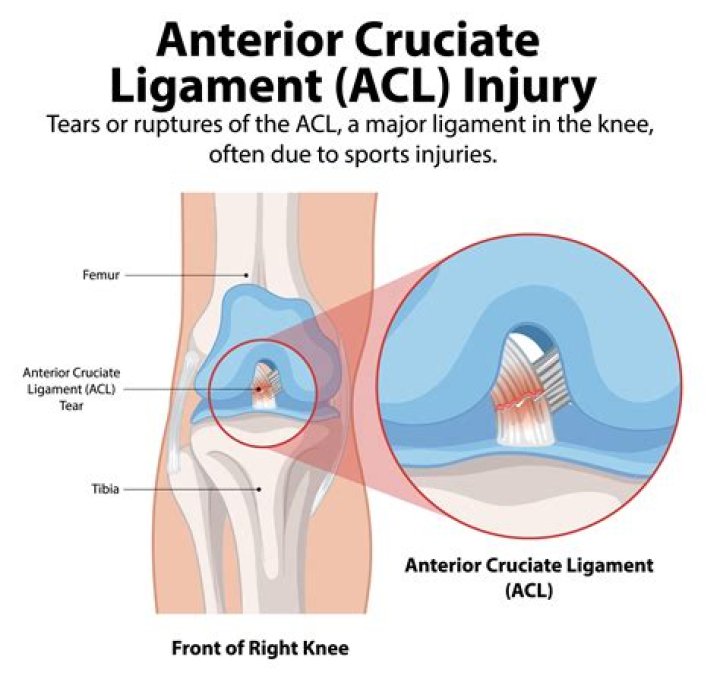 What sport do you tear your ACL the most?