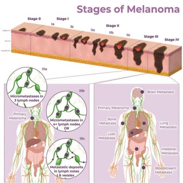 What stage is most melanoma diagnosed?