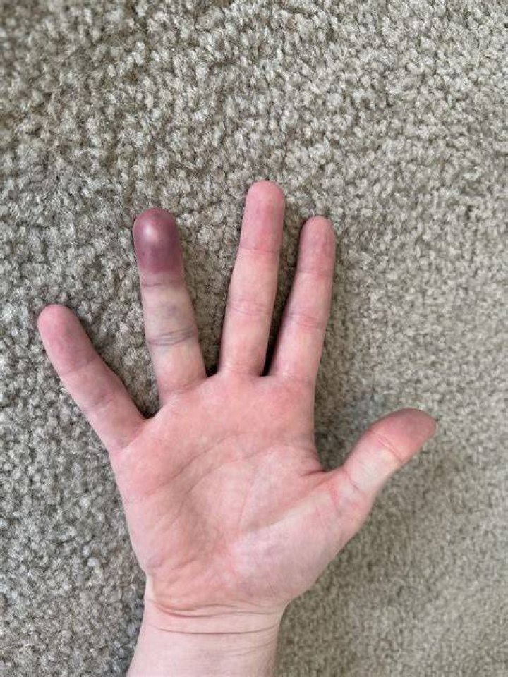 What to do if you smashed your finger and blood is under it?