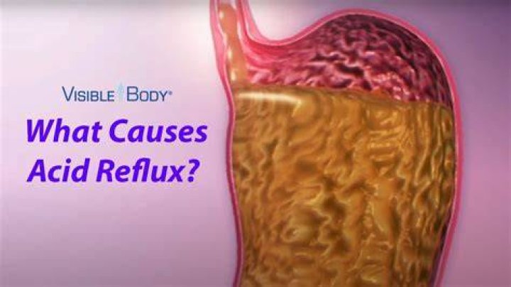 What vitamins can cause acid reflux?