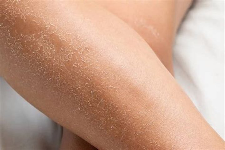 What xerosis looks like?