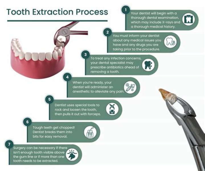 When a tooth is extracted what happens to the nerve?