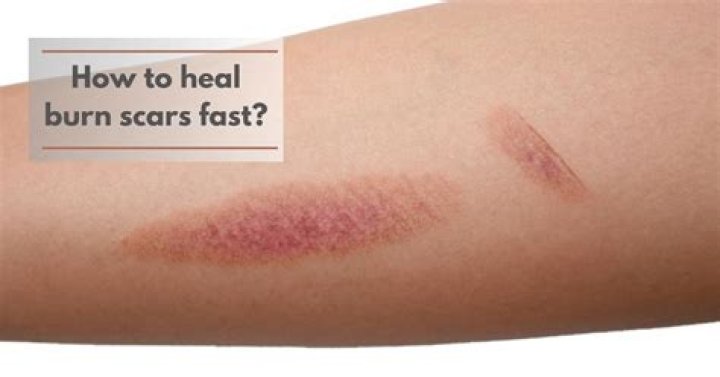 When does a scar stop healing?