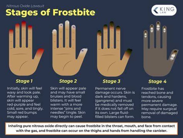 When should you go to the hospital for frostbite?