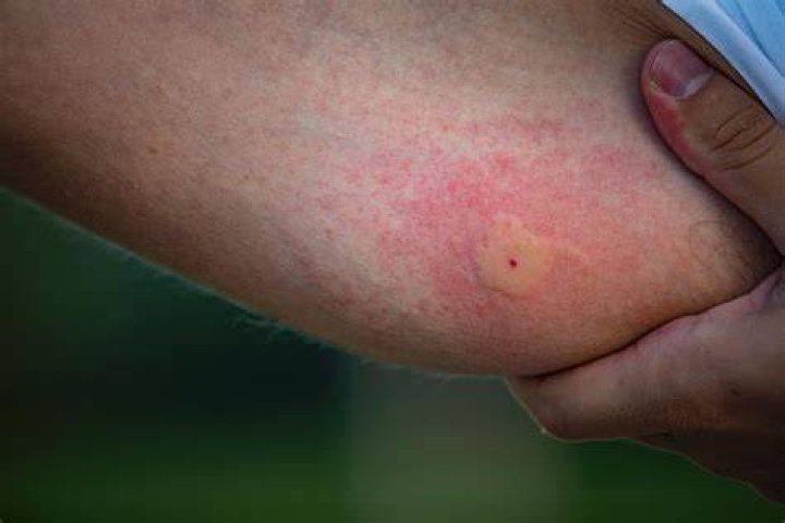 When should you worry about a hematoma?