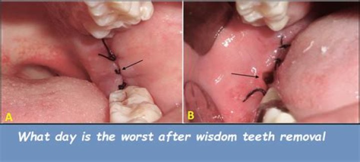 Which day is worse after wisdom teeth removal?