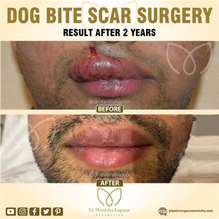 Which medicine is best for dog bite?