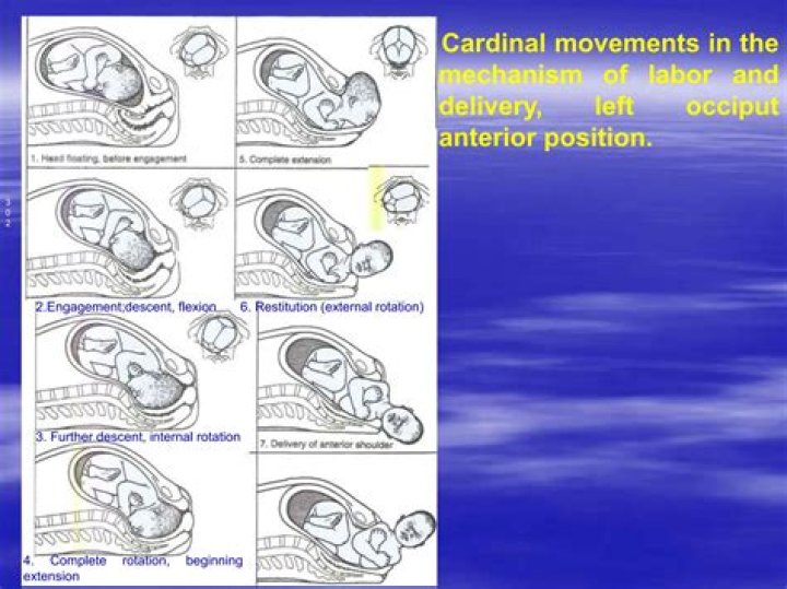Which of the seven cardinal movements is occurring immediately after the fetal head is born?