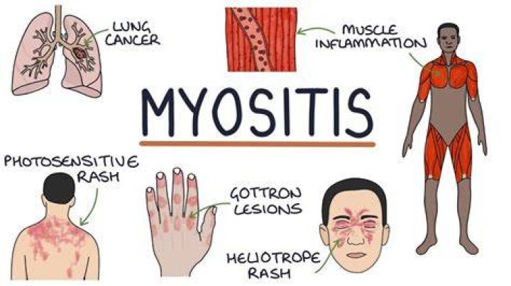 Which virus is the best known cause of myositis?