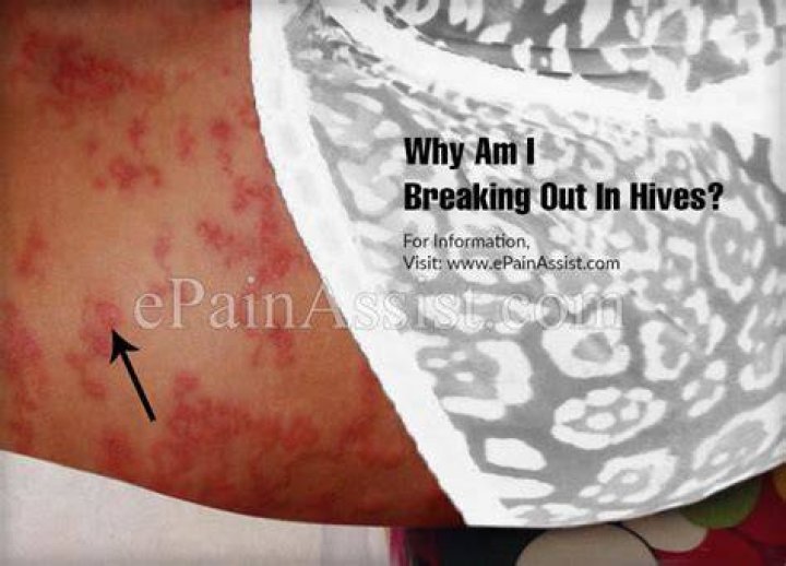Why am I breaking out in hives?