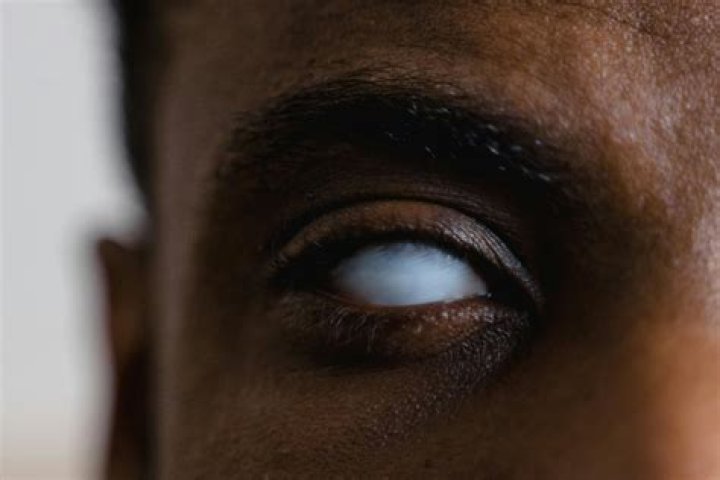 Why are blind eyes white?