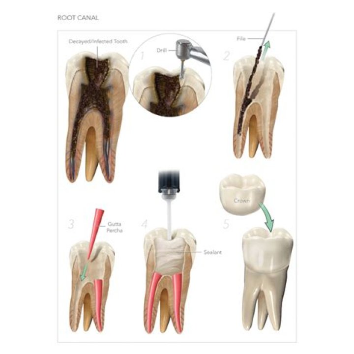 Why are root canals done in 3 visits?