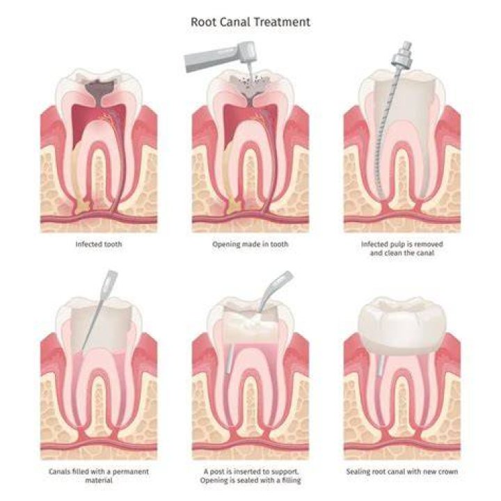 Why do dentists always want to do root canals?